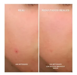 Hot Bye Bye Breakout Serums