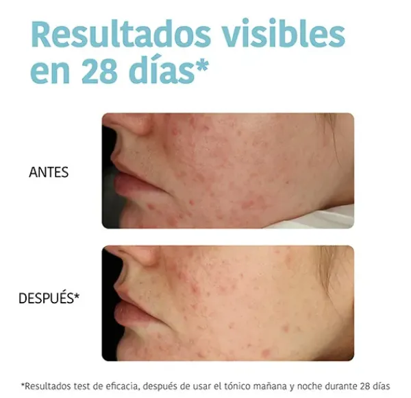 Exfoliating Anti-Blemish*IROHA NATURE Clearance